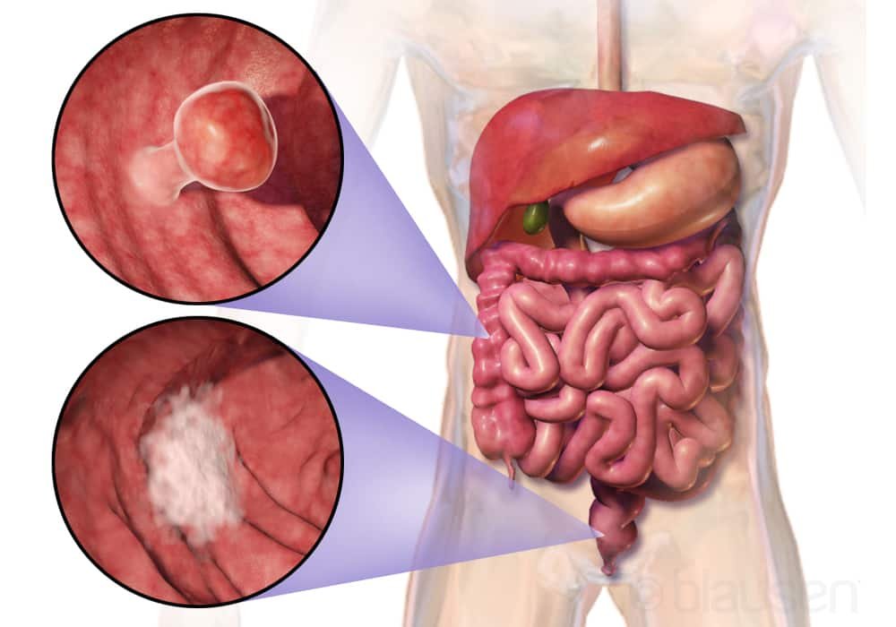 Colon cancer colorectal