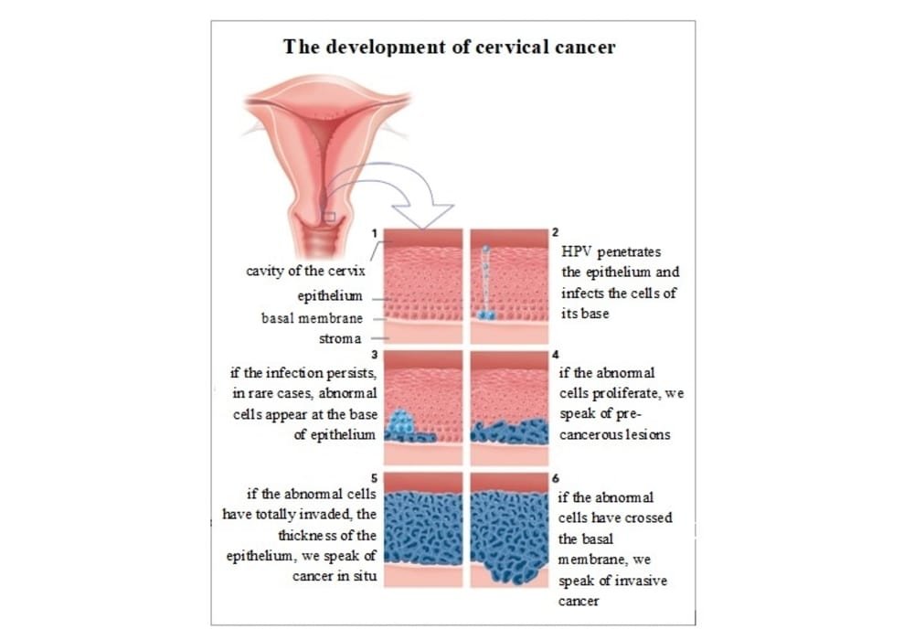 Development cervical cancer