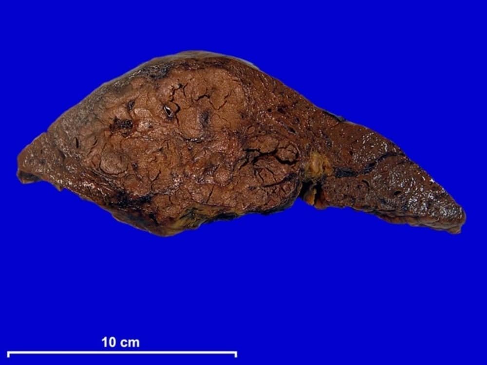 Liver Cancer (Hepatocellular Carcinoma) | Symptoms, Stages, Types, Diagnoses, Chances of Surviving, Treatments
