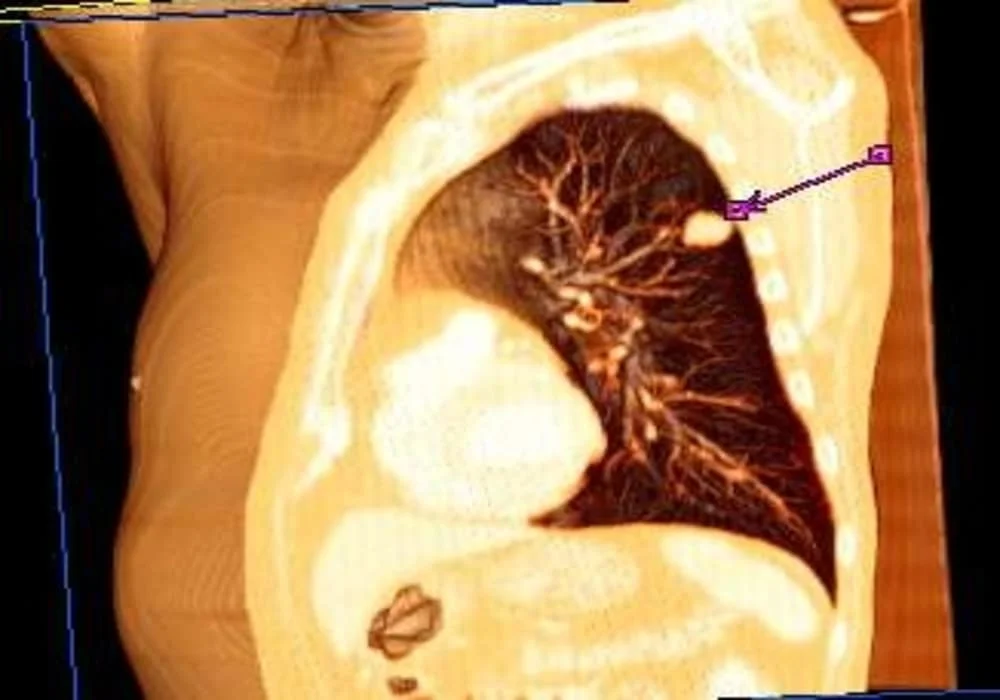 Lung cancer carcinoma