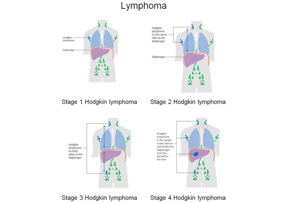 Lymphoma Hodgkin and Non Hodgkin | Symptoms, Stages, Types, Diagnoses, Chances of Surviving, Treatments
