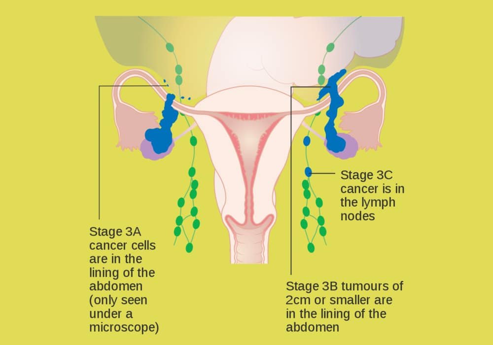 Ovarian Cancer | Symptoms, Stages, Types, Diagnoses, Chances of Surviving, Treatments