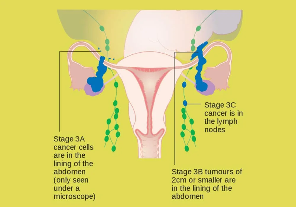 Ovarian cancer stages