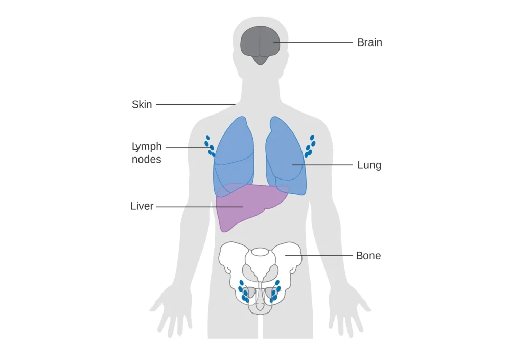 Types of cancer