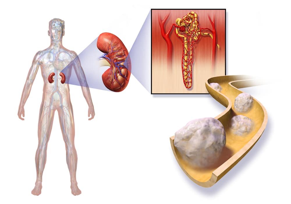 kidney-cancer-symptoms-stages-types-diagnoses-treatments