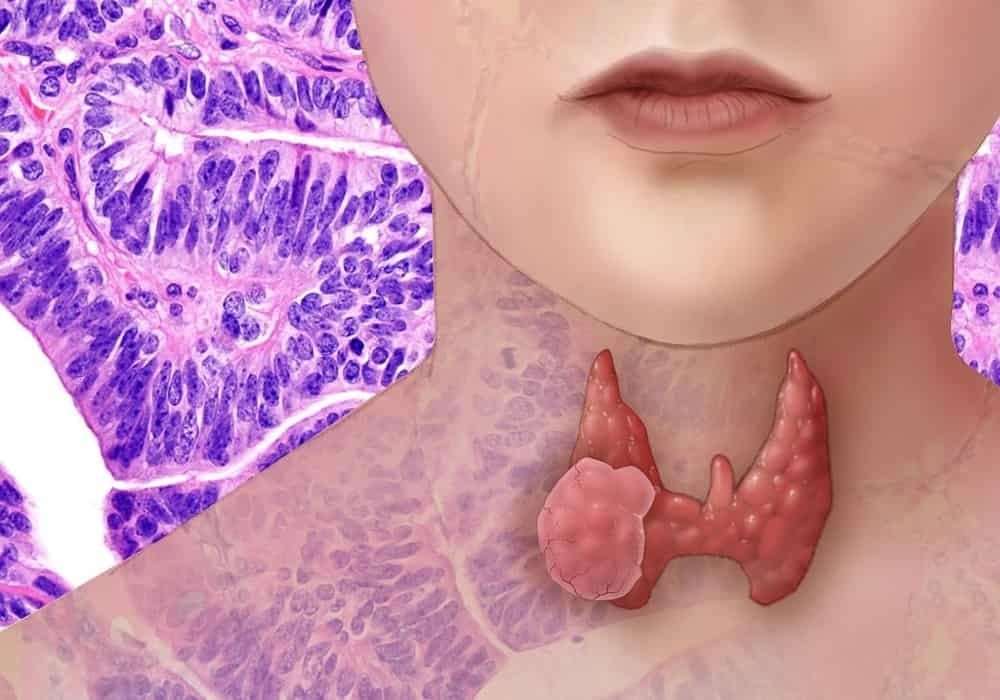 Thyroid Cancer | Symptoms, Stages, Types, Diagnoses, Chances of Surviving, Treatments