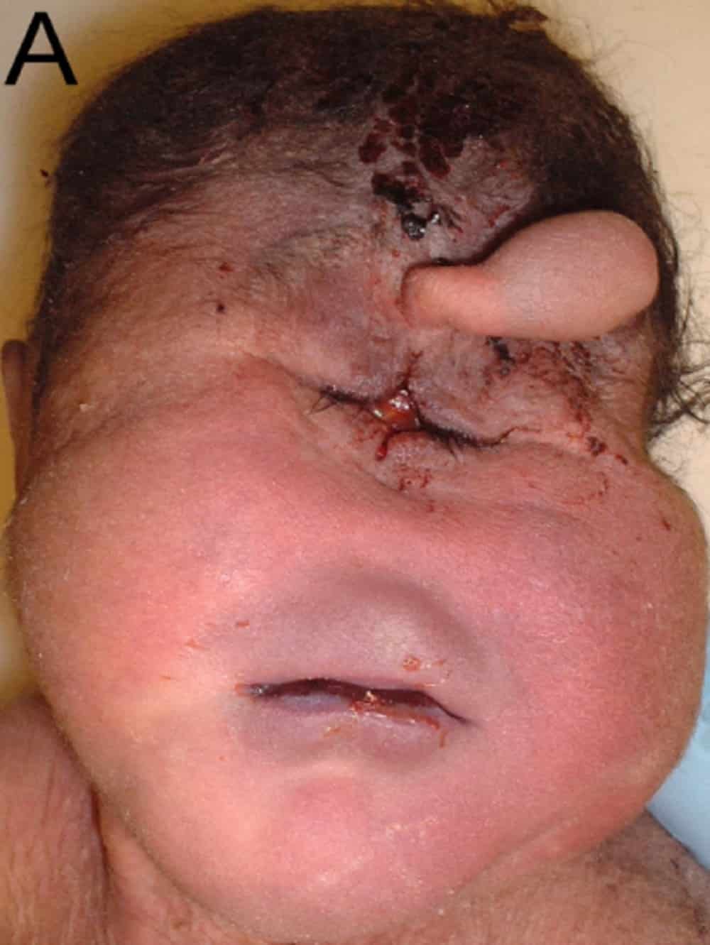 Trisomy 13 or patau syndrome