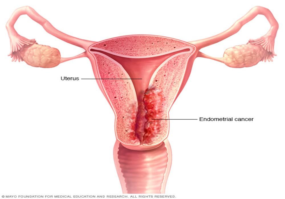 Uterine Cancer endometrial (womb cancer)