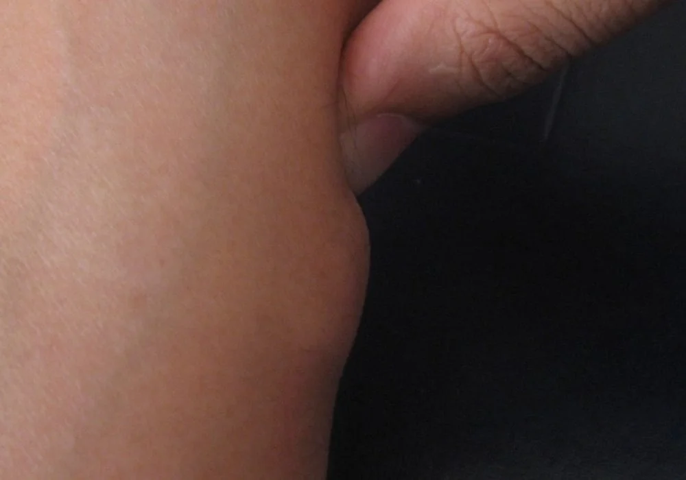 Lipoma is a fat benign tumor (skin lumps) - Symptoms, Treatments, Risks