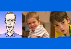 Fragile X syndrome (FXS) or Martin Bell Syndrome (MBS) causes intellectual disability, behavioral problems, and physical abnormalities