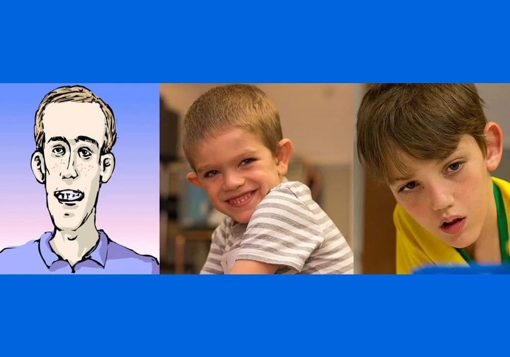 Fragile X syndrome (FXS) or Martin Bell Syndrome (MBS) causes intellectual disability, behavioral problems, and physical abnormalities