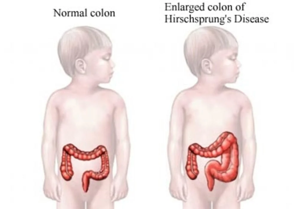 Hirschsprung Disease | Colon Blockage | Symptoms, Prevention, Treatment