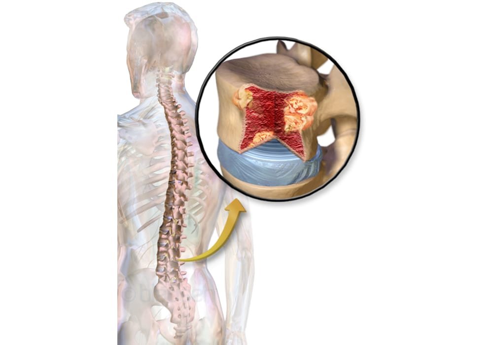 Multiple Myeloma (MM) | Symptoms, Stages, Types, Diagnoses, Chances of Surviving, Treatments