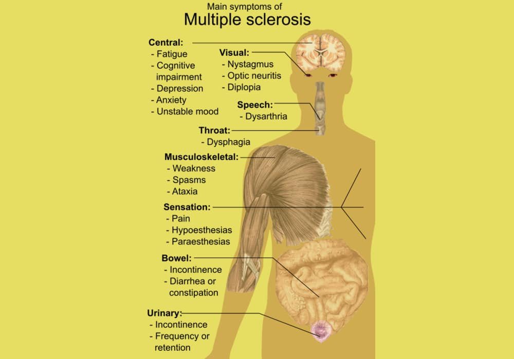 Multiple Sclerosis (MS) potentially disabling disease of the brain and spinal cord (central nervous system)