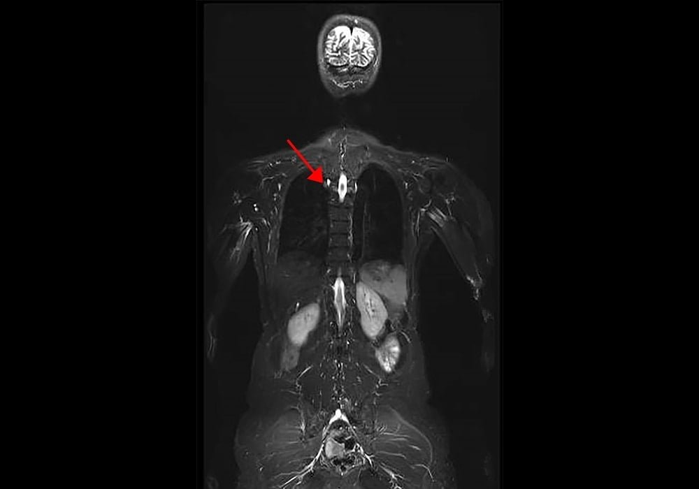 Li-Fraumeni Syndrome (LFS) | Also known as the sarcoma, breast, leukaemia and adrenal gland (SBLA) syndrome