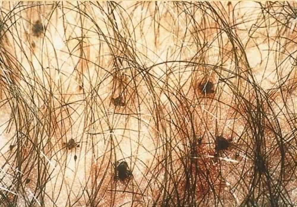 Pubic lice in genital area