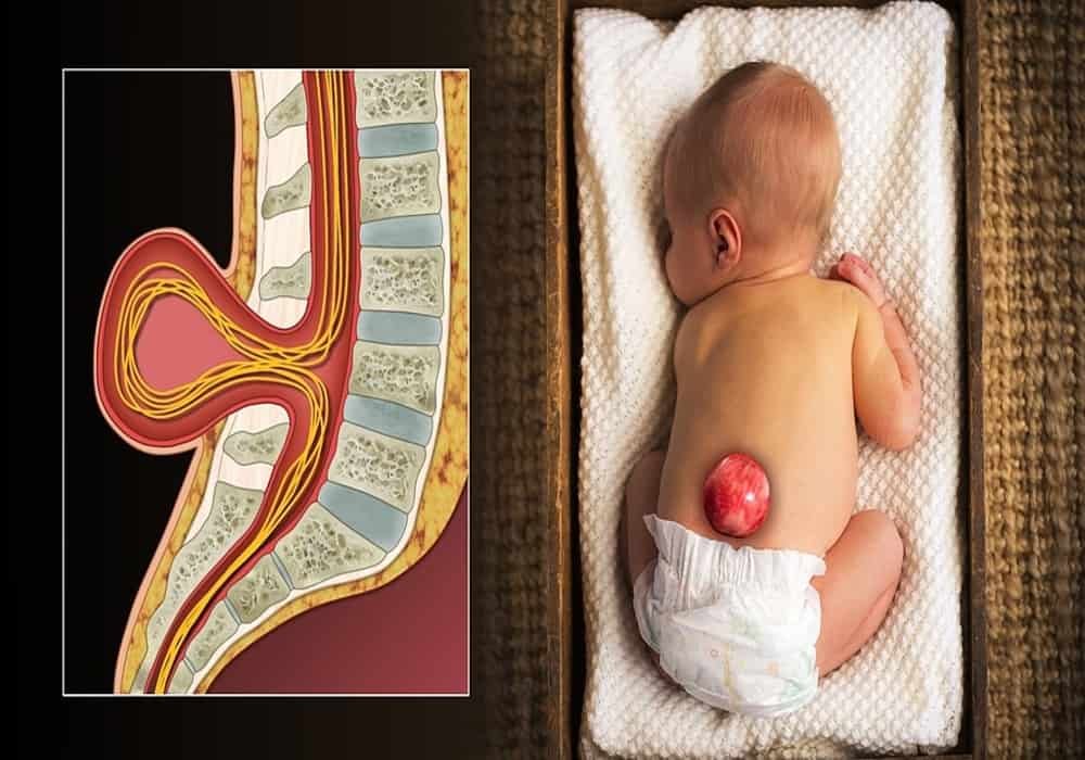 Spina Bifida: malformation caused by the poor development of the spine and spinal cord in the uterus