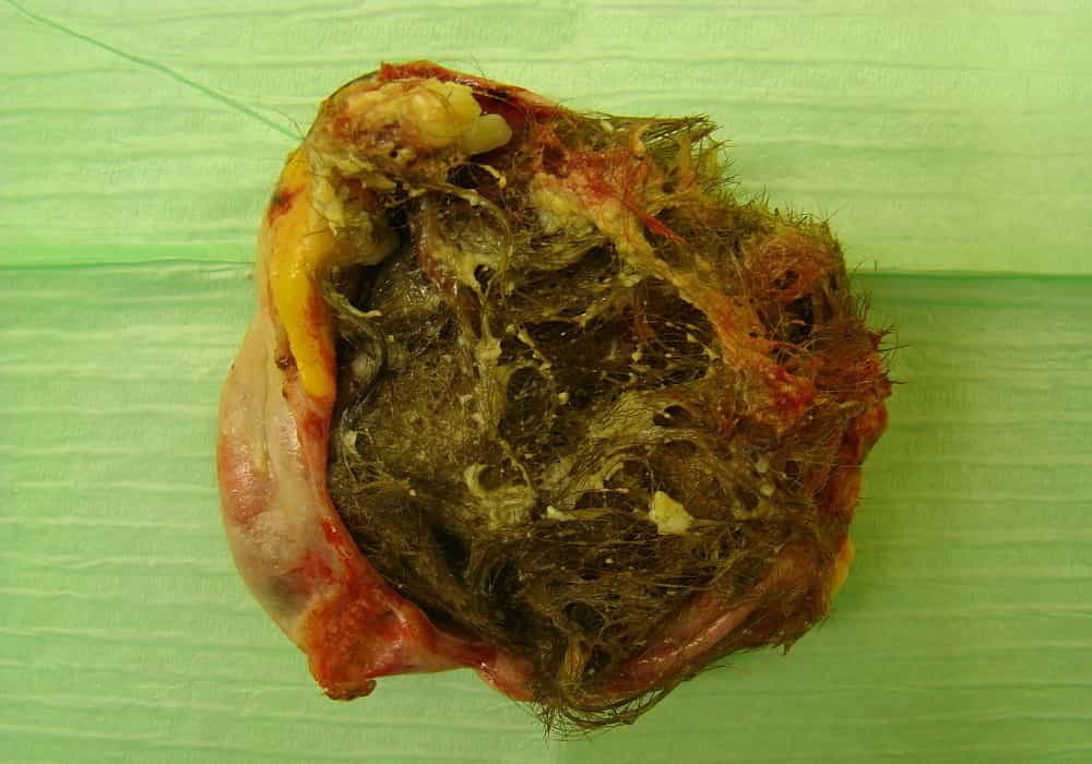 Teratoma of the ovary with hair and teeth