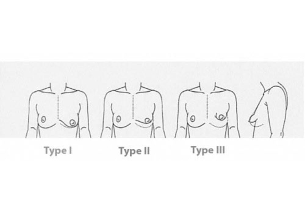 Tubular Breast (Tuberous Breasts) Malformation of Breasts