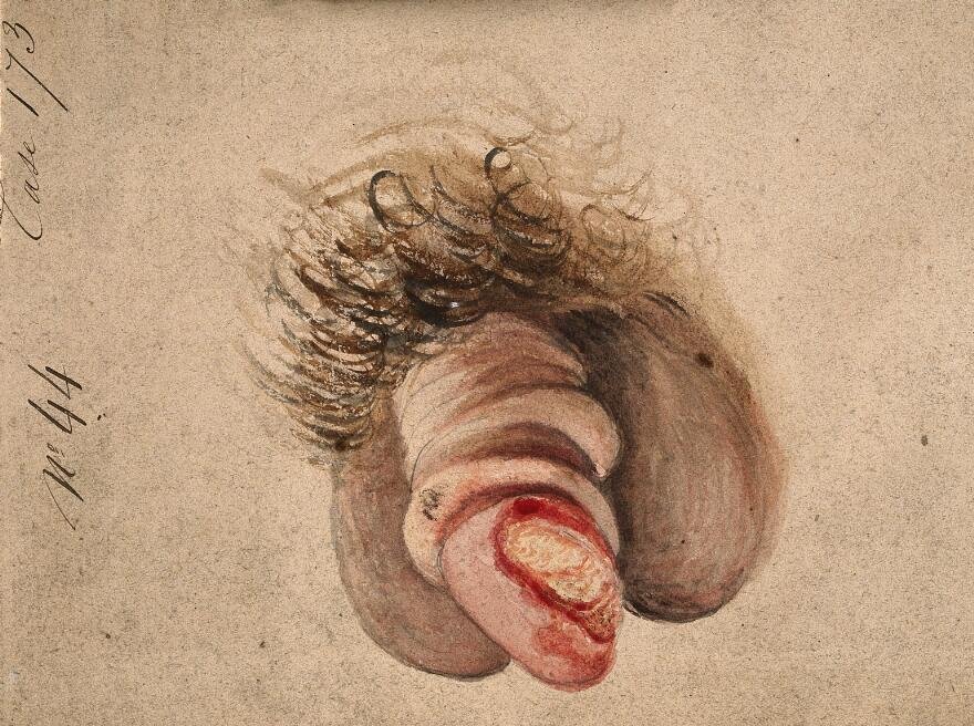 Diseased penis with decorticating chancre