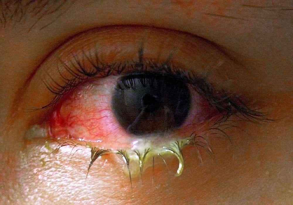Eye Diseases and Common Eye Problems (List of eye diseases and disorders)
