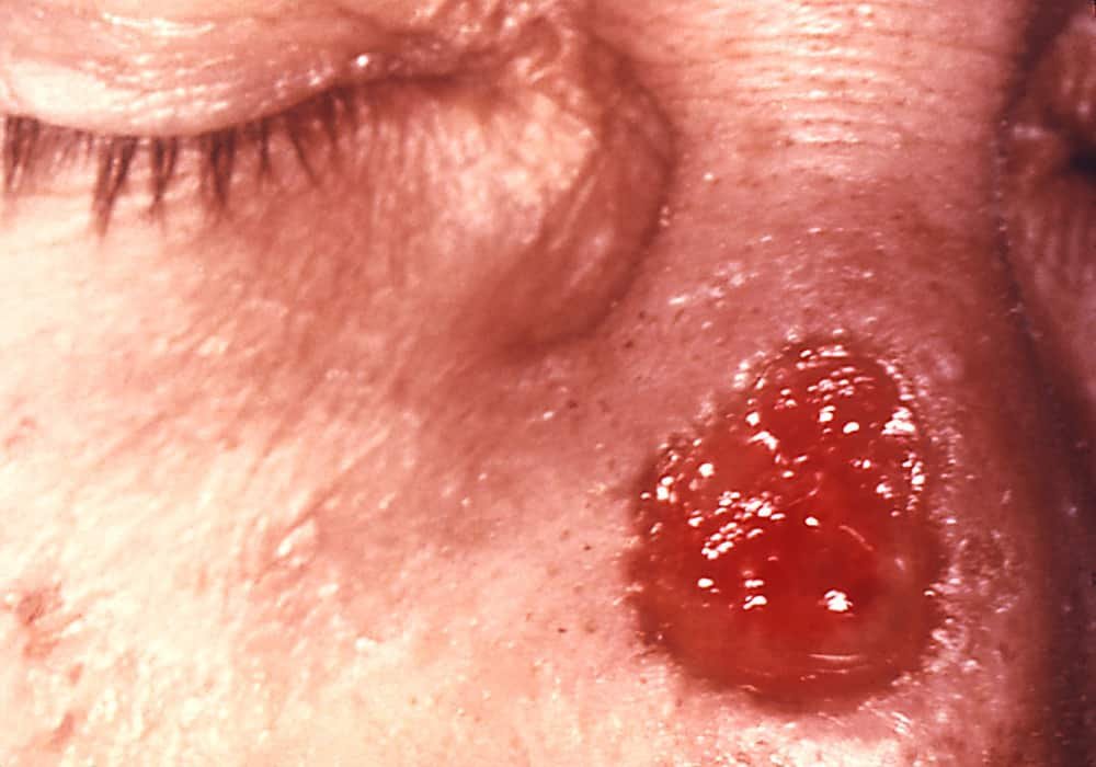 Photo tertiary syphilis