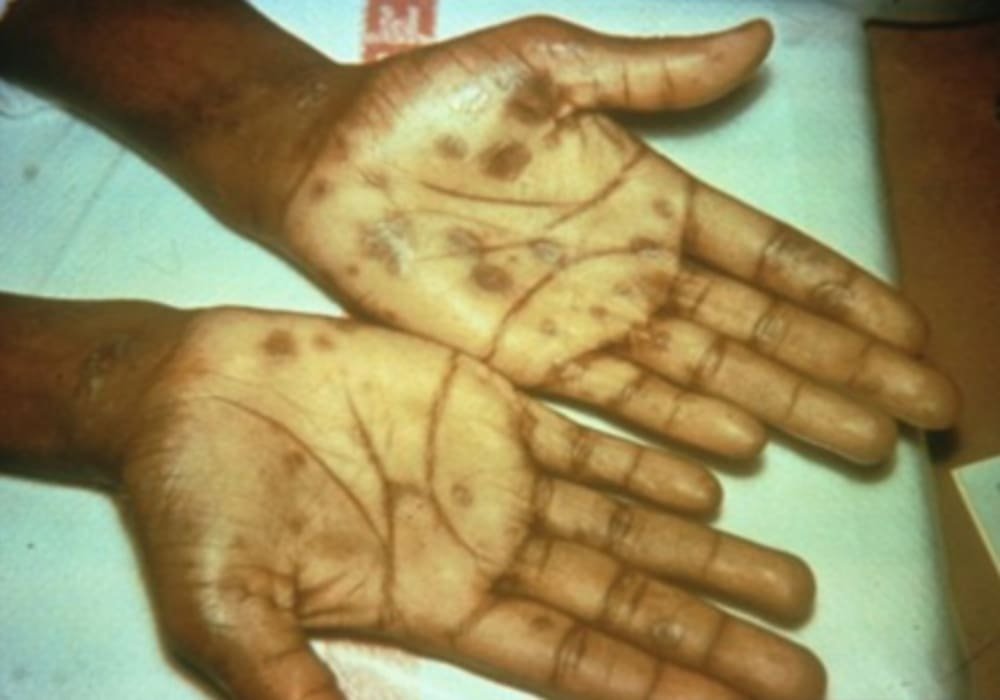 Typical presentation of secondary syphilis with a rash on the palms of the hands