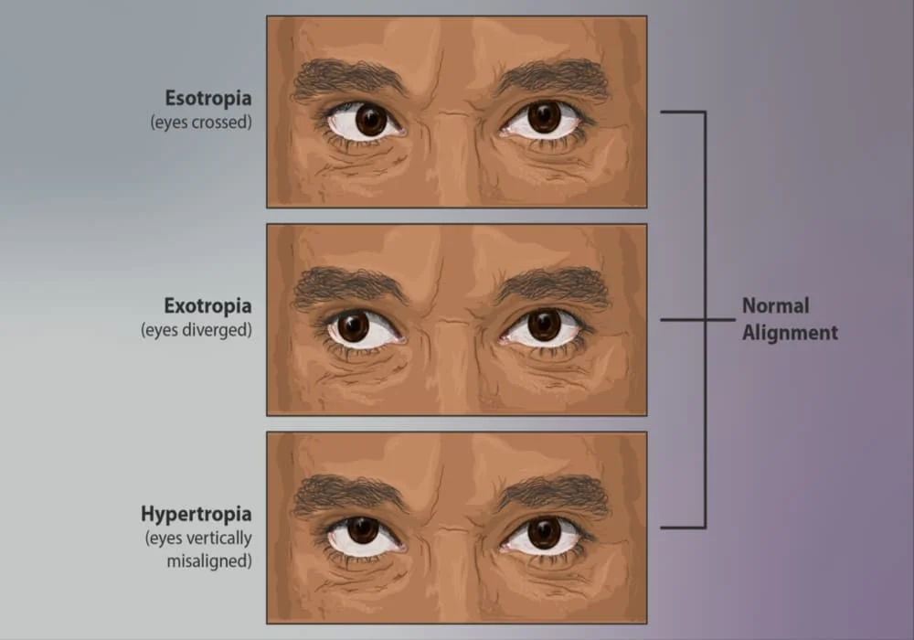 Strabismus (crossed eyes: esotropia, extropia, hypertropia) | Causes, Types, Treatments