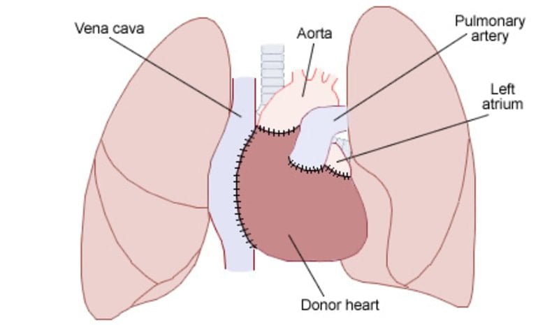 Heart transplant | 1st Human heart transplant surgery was performed on December 3, 1967 by Dr Barnard