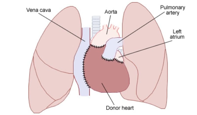 Heart transplant