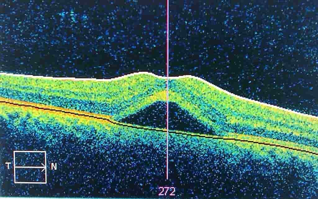 Central Serous Chorioretinopathy (Retinal Disease)