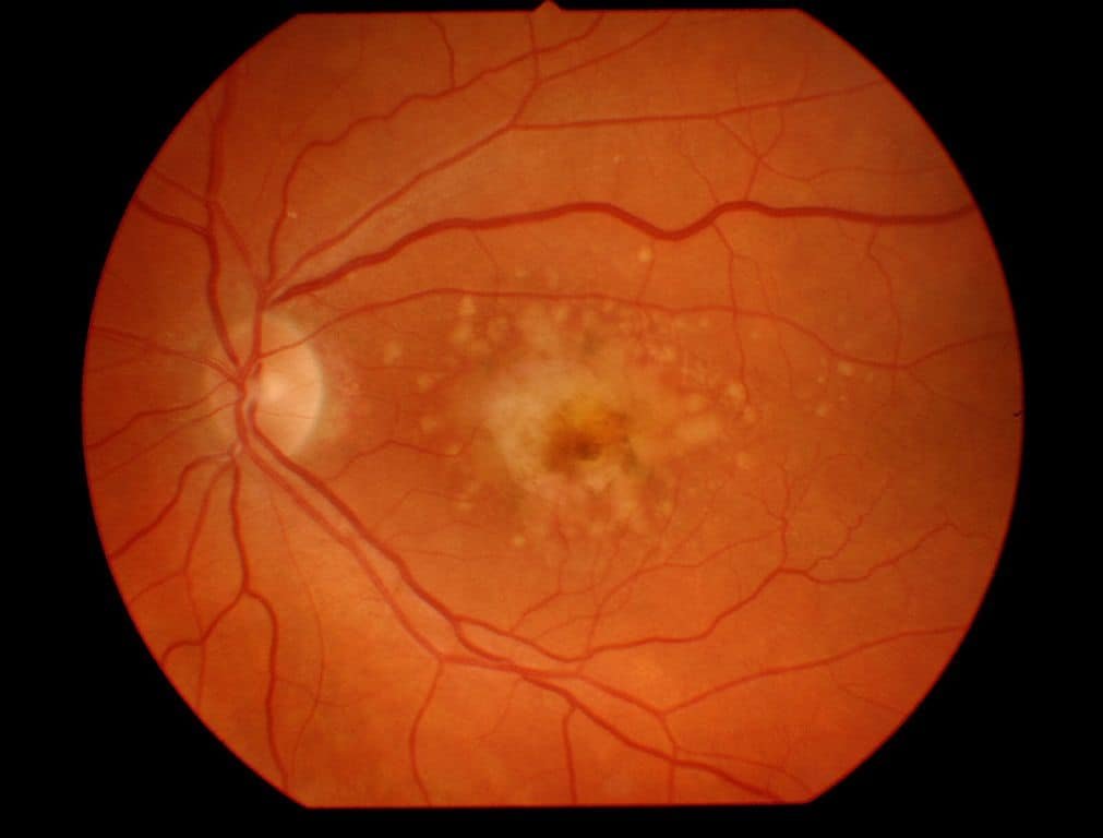 Macular degeneration one of the retinal diseases