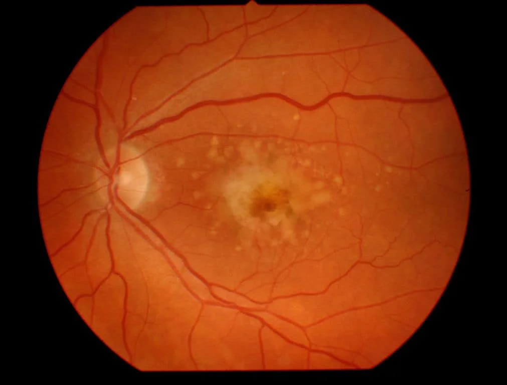 Macular degeneration one of the retinal diseases
