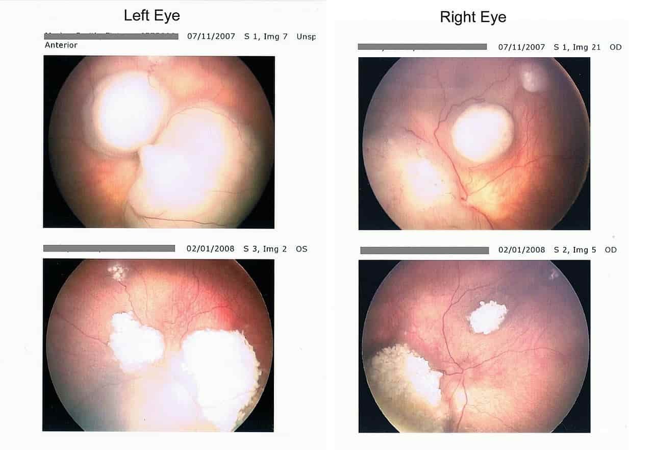 Retinal Cancer | Choroidal melanoma, Choroidal metastases, Symptoms, Diagnostic, Treatment