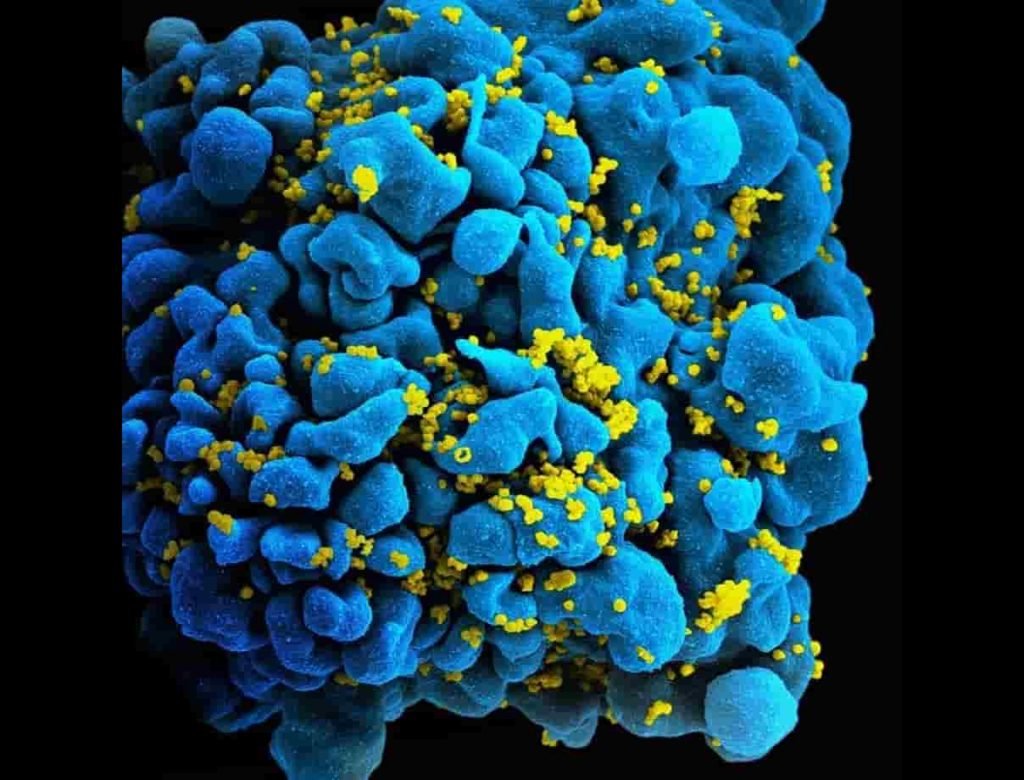 Hiv cured