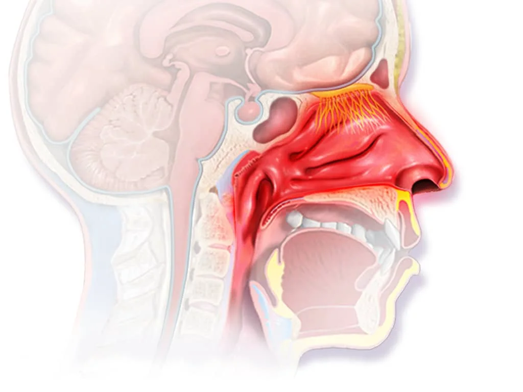 Rhinitis Nonallergic | Symptoms, causes, treatments and prevention