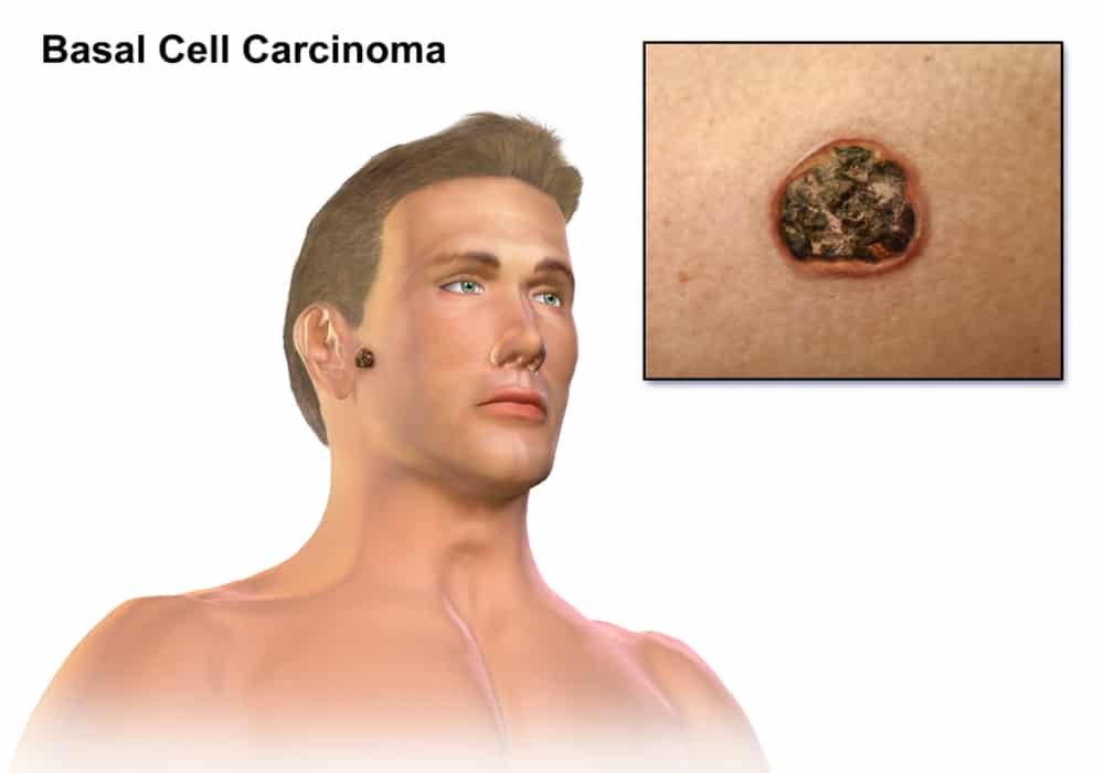 Carcinoma | Symptoms and treatments of this skin cancer