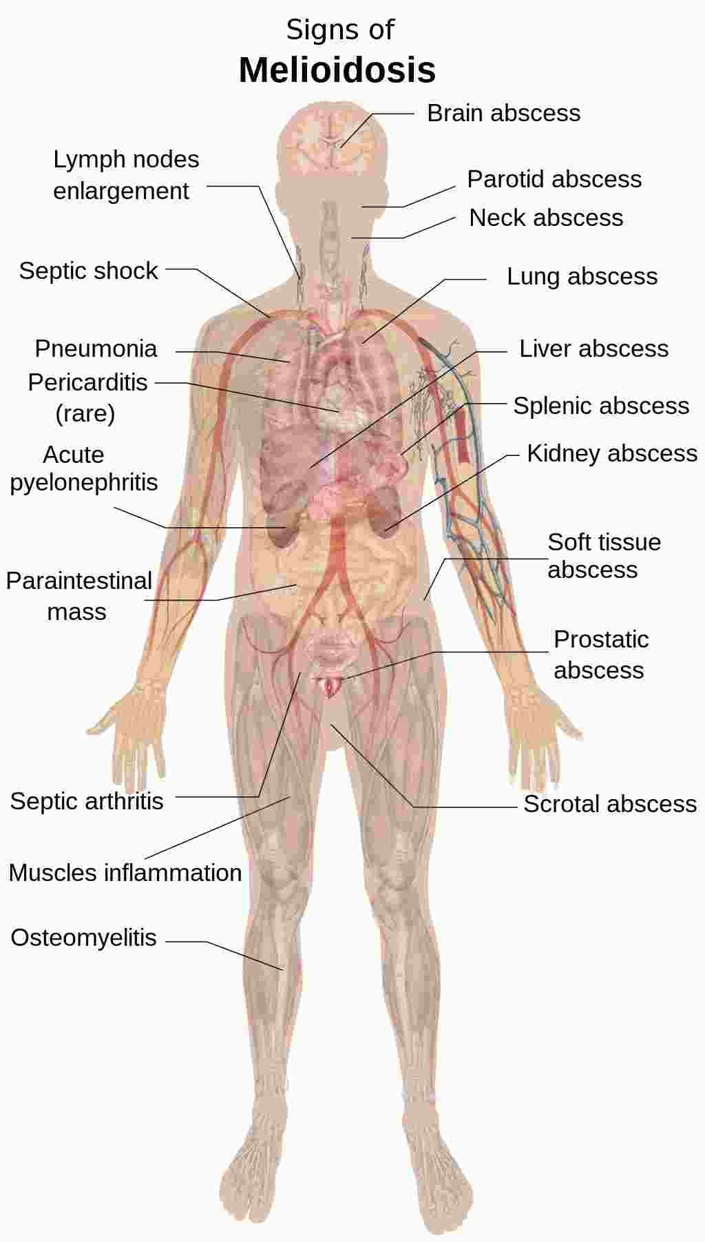 Melioidosis causes pneumonia, abscess formation, or infection (Whitmore’s disease)