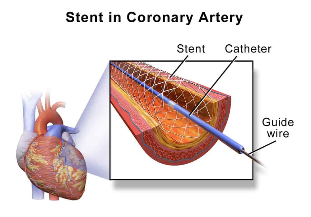 Angioplasty stent coronary artery disease