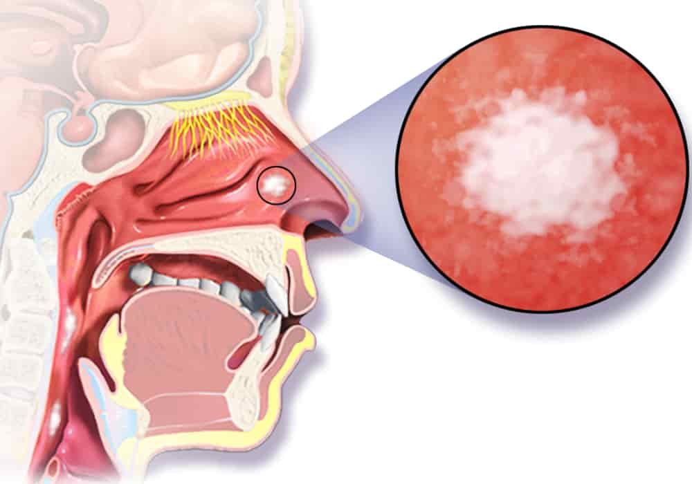 Head and Neck Cancers: Types, Symptoms, Diagnosis, and Treatment Options